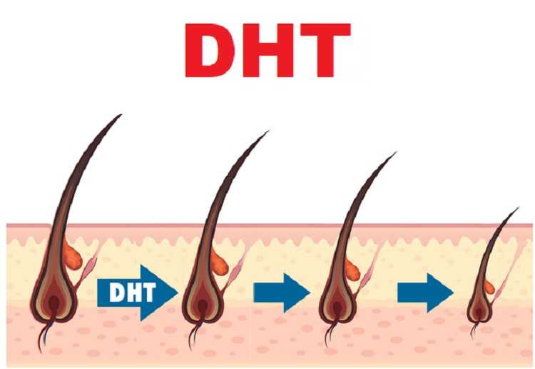 DHT ảnh hưởng đến sự phát triển tóc