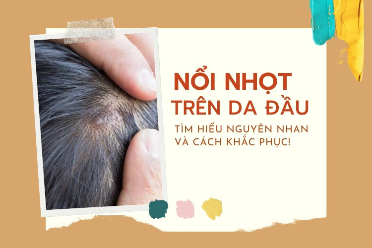 Nổi Nhọt Trên Da Đầu Do Đậu? Làm Sao Để Khắc Phục?