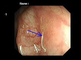 Nội soi đại tràng xác định Giun tóc