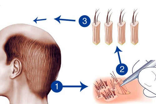 Phẫu thuật cấy tóc