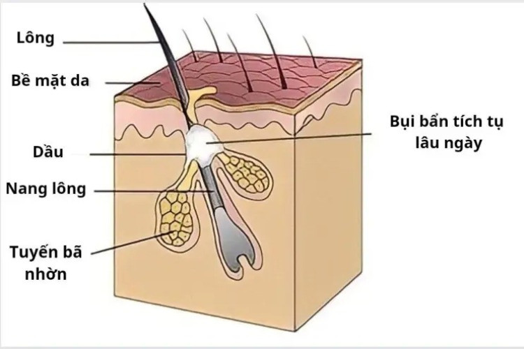 Tác Nhân Gây Nổi Nhọt Da Đầu