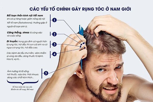 Yếu tố di truyền gây rụng tóc